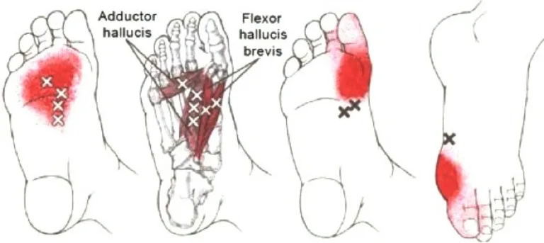 Foot diagram of bunions AAFT