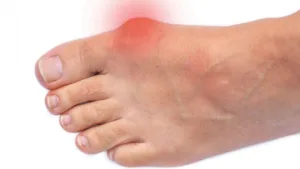 Bunion-pain_1692x952a