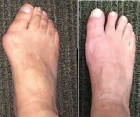 Bunion-before-and-after